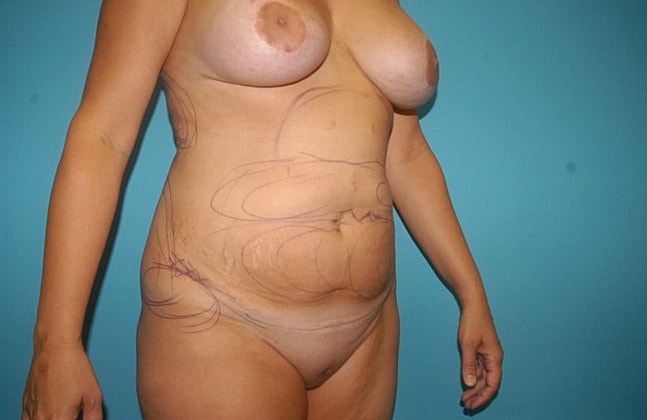 Liposuction Before & After