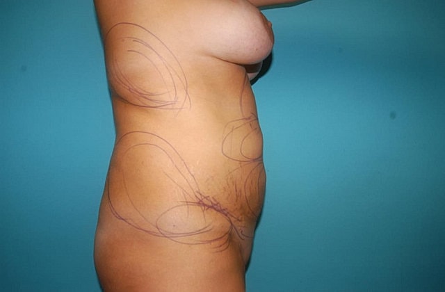 Liposuction Before & After
