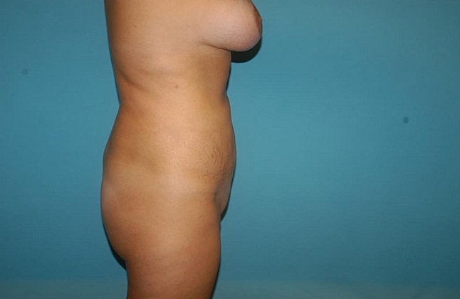 Liposuction Before & After