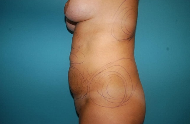 Liposuction Before & After