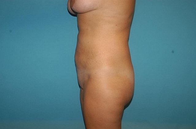 Liposuction Before & After
