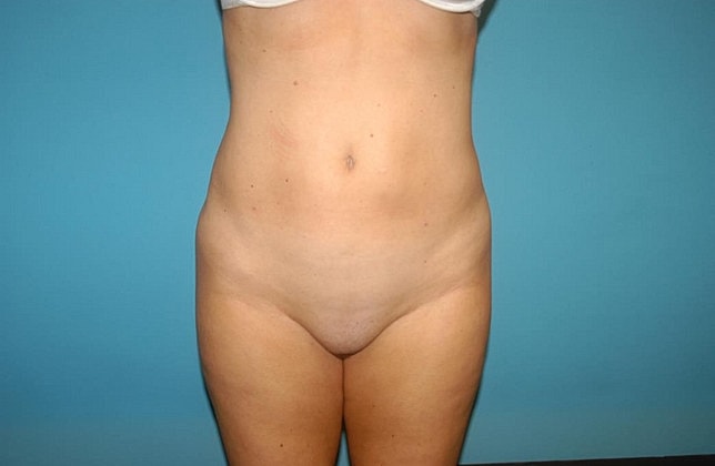 Liposuction Before & After