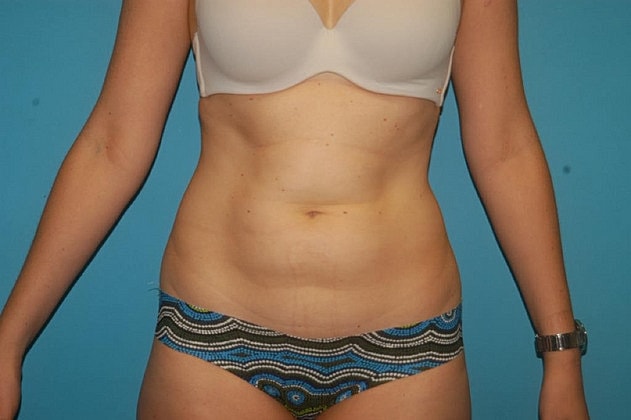 Liposuction Before & After