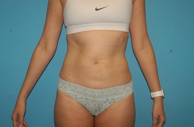 Liposuction Before & After