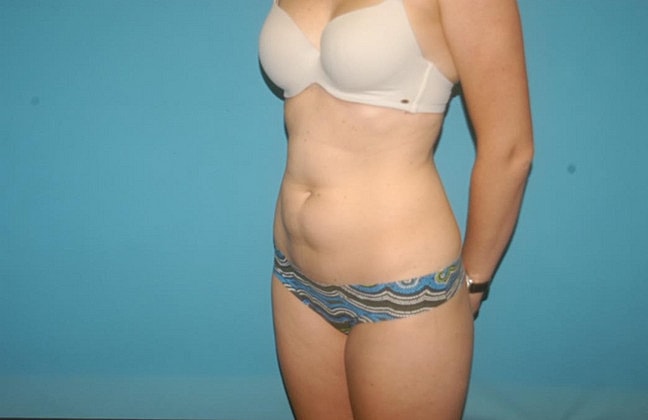 Liposuction Before & After