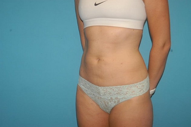 Liposuction Before & After