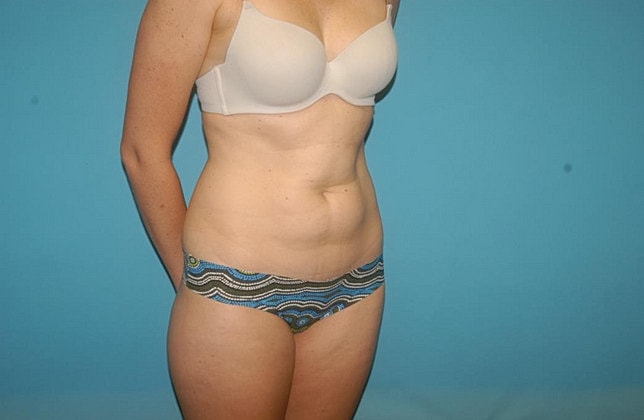 Liposuction Before & After