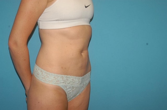 Liposuction Before & After