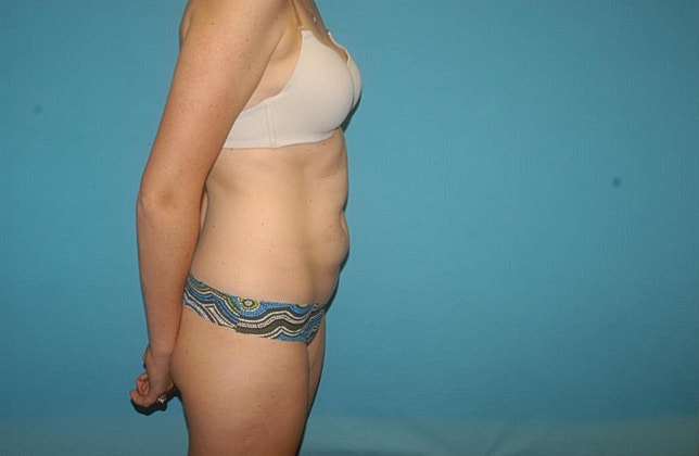 Liposuction Before & After