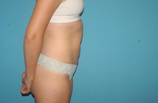 Liposuction Before & After