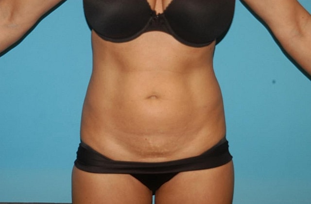 Liposuction Before & After