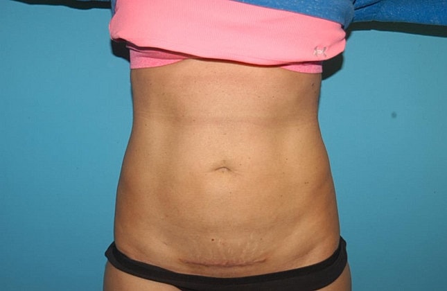 Liposuction Before & After