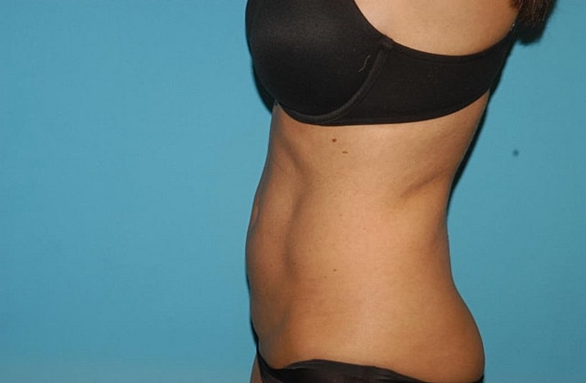 Liposuction Before & After