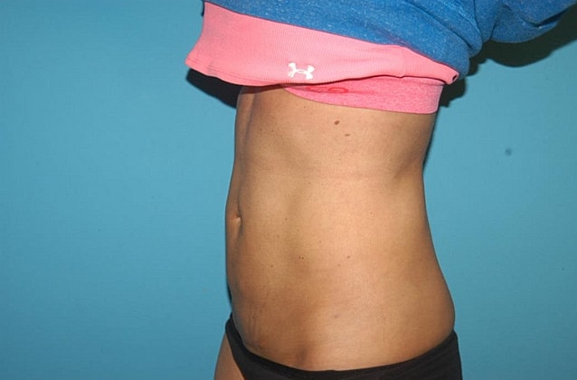 Liposuction Before & After