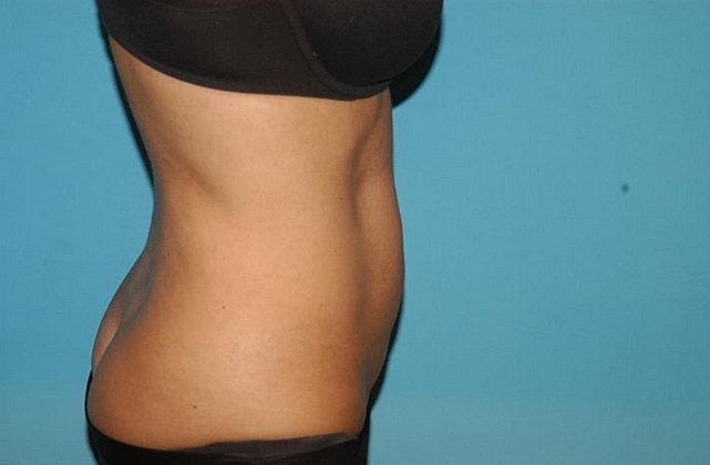 Liposuction Before & After