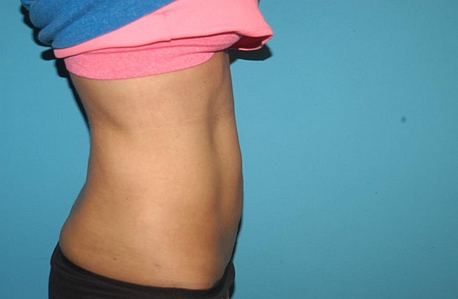 Liposuction Before & After