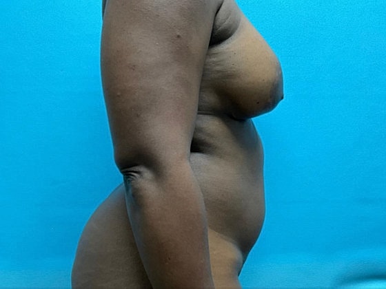 Liposuction Before & After