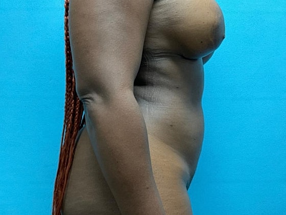 Liposuction Before & After