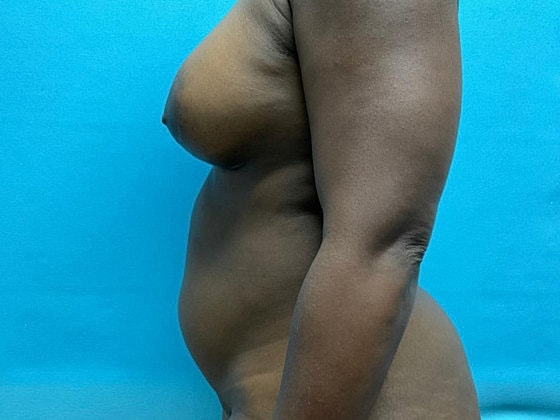 Liposuction Before & After