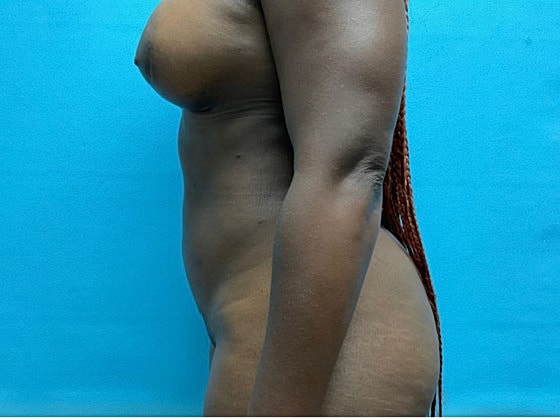 Liposuction Before & After