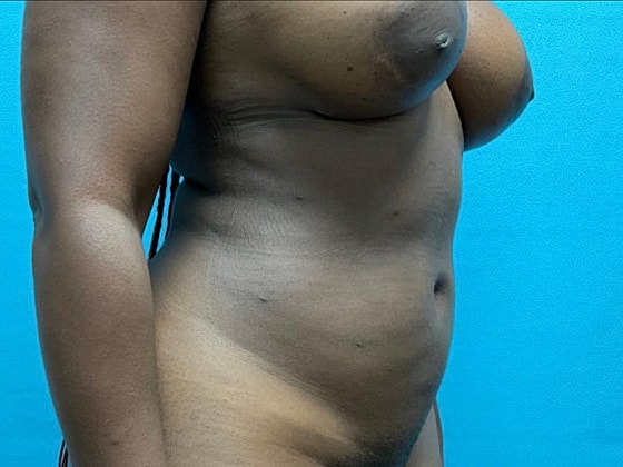 Liposuction Before & After