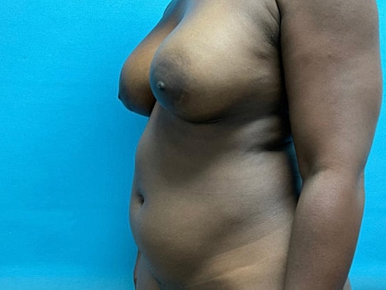 Liposuction Before & After