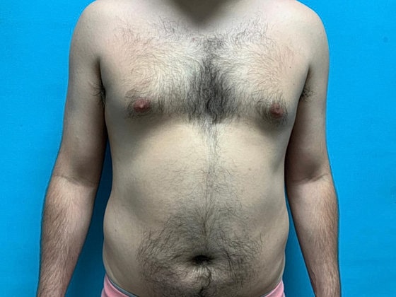 Liposuction Before & After