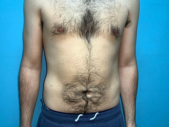Liposuction Before & After