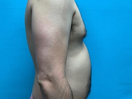 Liposuction Before & After
