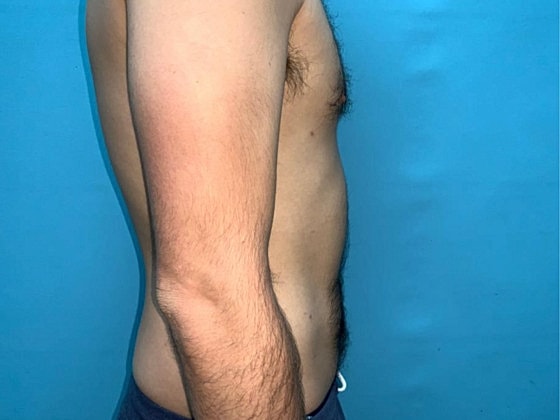 Liposuction Before & After