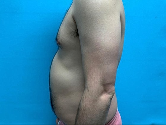 Liposuction Before & After