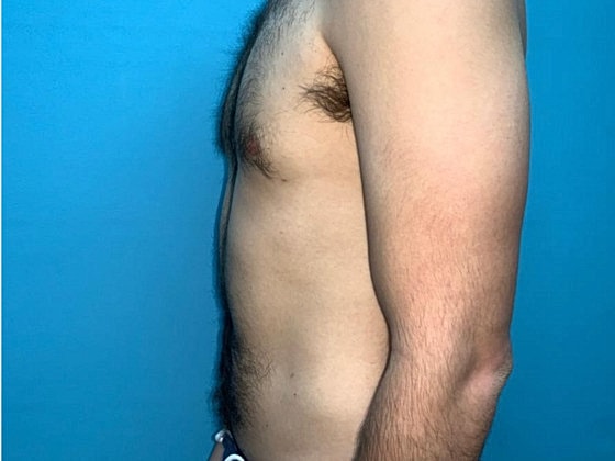 Liposuction Before & After