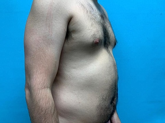 Liposuction Before & After