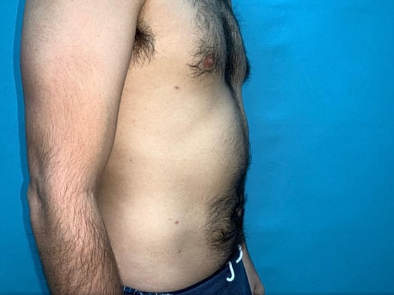 Liposuction Before & After