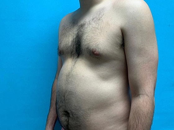 Liposuction Before & After