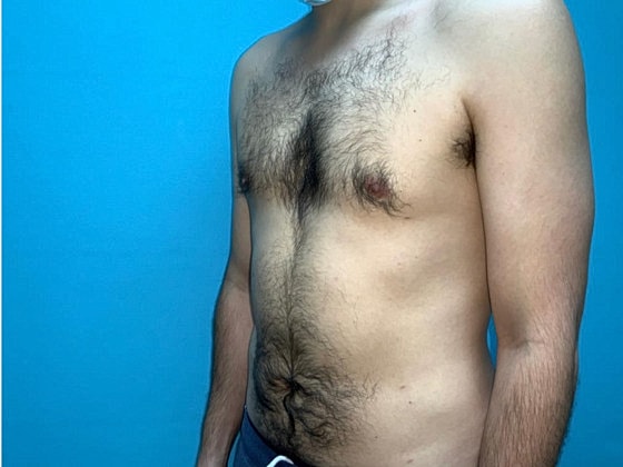 Liposuction Before & After