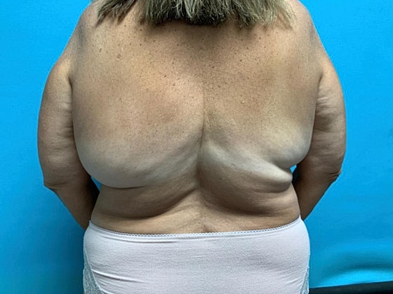 Liposuction Before & After