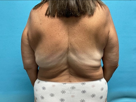 Liposuction Before & After