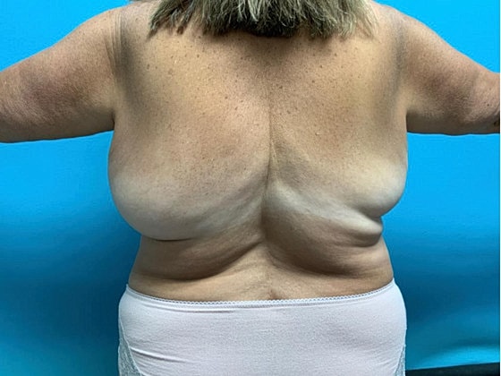 Liposuction Before & After