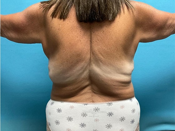 Liposuction Before & After