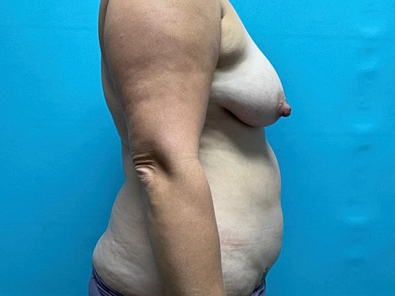 Liposuction Before & After