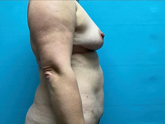 Liposuction Before & After