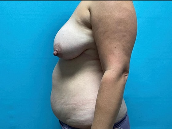 Liposuction Before & After