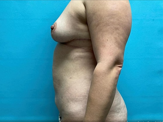 Liposuction Before & After