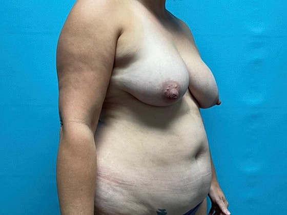 Liposuction Before & After