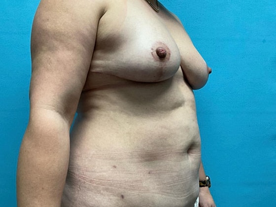 Liposuction Before & After