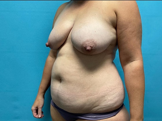 Liposuction Before & After