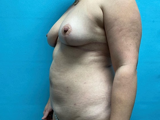Liposuction Before & After