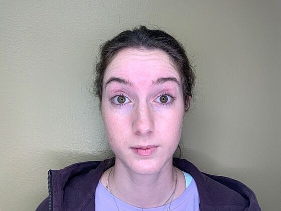 Botox Before & After