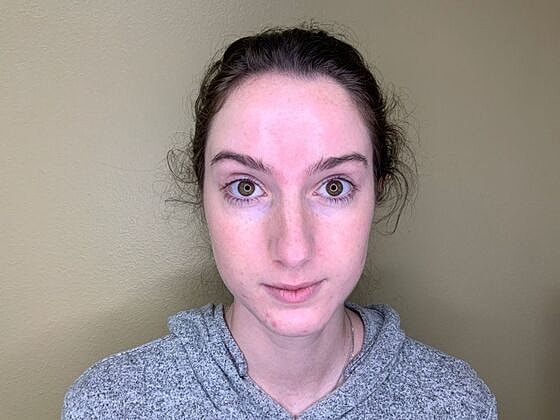 Botox Before & After